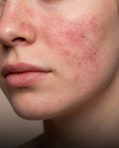 Sensitive skin
