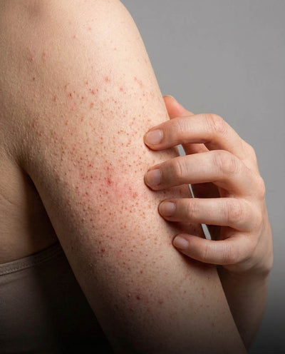 Keratosis pilaris