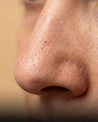 Blackheads