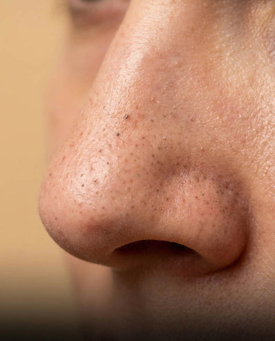 Blackheads