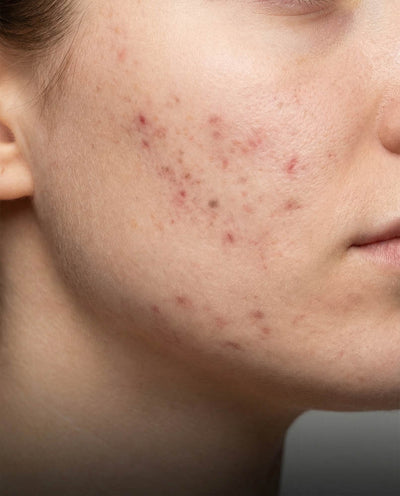 Post-blemish marks