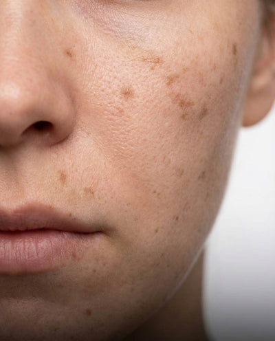 Dark spots