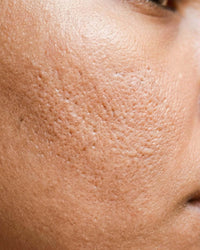 Enlarged Pores