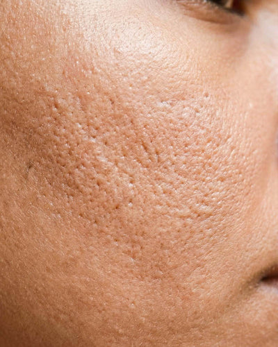 Enlarged pores