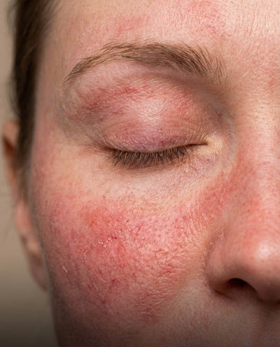 Rosacea-prone skin