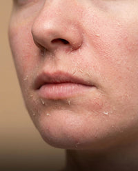 Dehydrated & dry skin