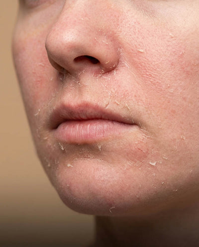 Dry skin