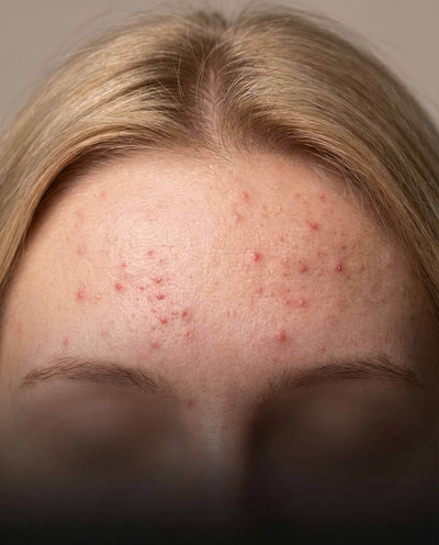 Blemishes